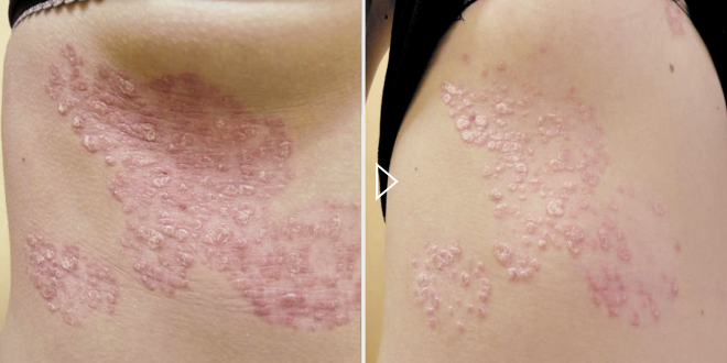 Behandlung von Psoriasis – Fotos vor und nach der Behandlung