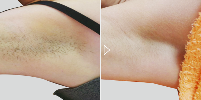 Laser-Haarentfernung – Vorher-Nachher-Fotos