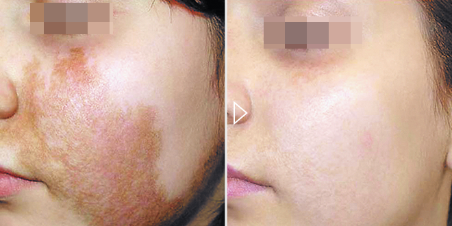 Behandlung von Hyperpigmentierung – Vorher-Nachher-Fotos