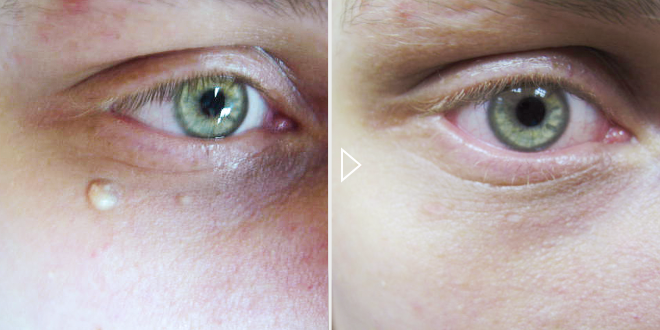 Entfernung von Muttermalen, Papillomen – Vorher-Nachher-Fotos