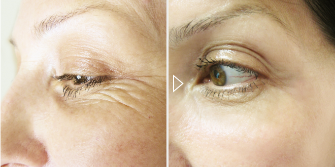 Laserbehandlung zur Hautverjüngung – Vorher-Nachher-Fotos