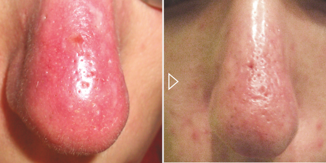 Laserbehandlung von Rhinophyma – Vorher-Nachher-Fotos
