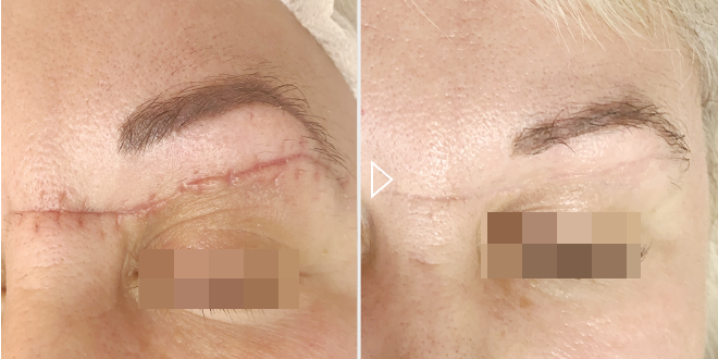 Entfernung von Narben und Narben - Vorher-Nachher-Fotos