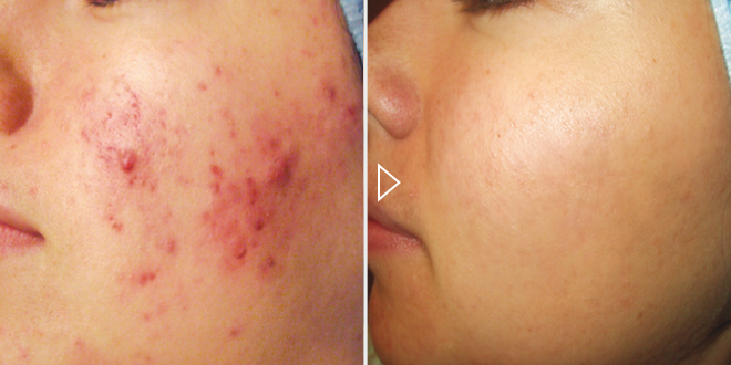 Entfernung von Mitessern und Pickeln – Vorher-Nachher-Fotos