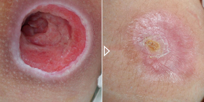 Beschleunigung der Heilung akuter und chronischer Wunden