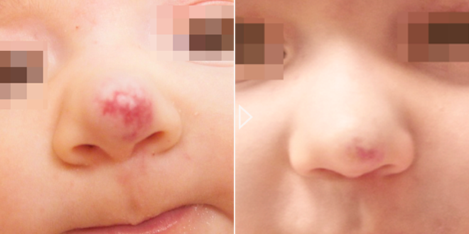 Behandlung von vaskulären Läsionen bei Kindern