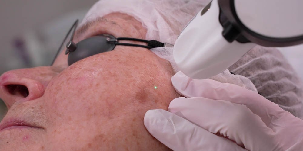 Behandlung pigmentierter Läsionen (Pinpoint Coagulation™)