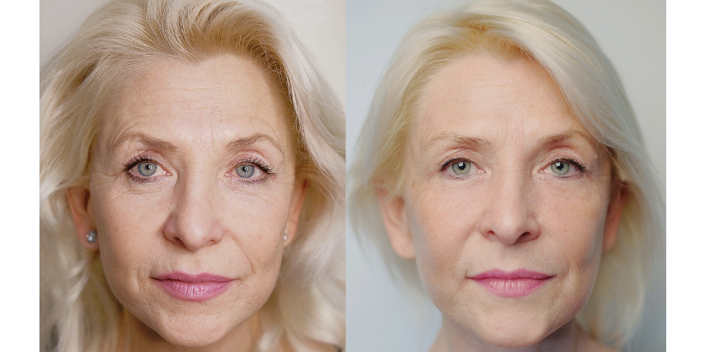 Er:YAG 2940 nm + SMA-Modul (RecoSMA®) – Ablation und regenerativer Emitter