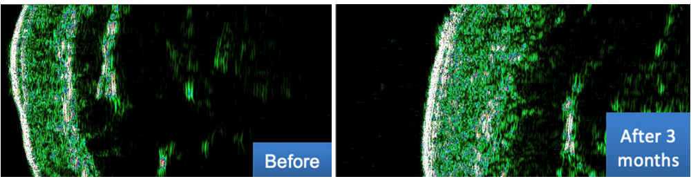 Ultraschallbild DUB Cutis, 22 MHz